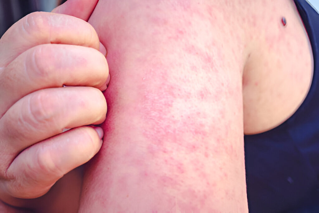 Skin Itching