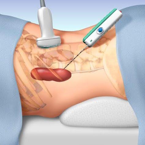 Kidney Biopsies